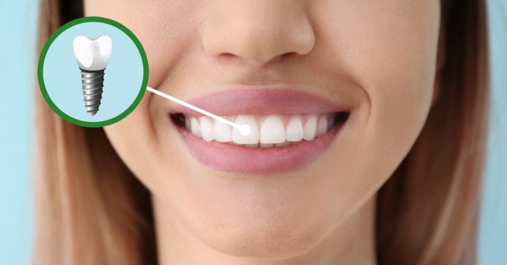 dental guided implants