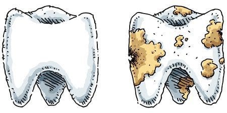 The plain truth about tooth decay tooth decay tooth decay