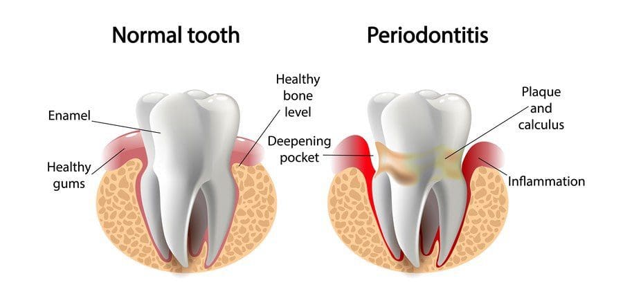 Prevention and Treatment of Periodontal Disease Periodontal Disease Prevention and Treatment of Periodontal Disease
