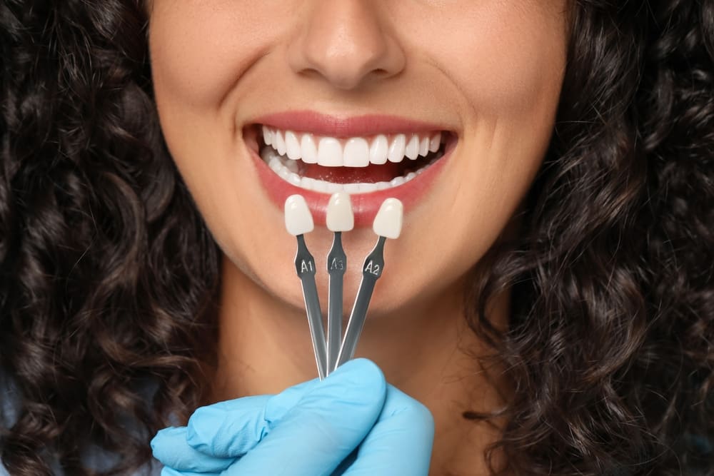 dental veneers in from of womans front teeth
