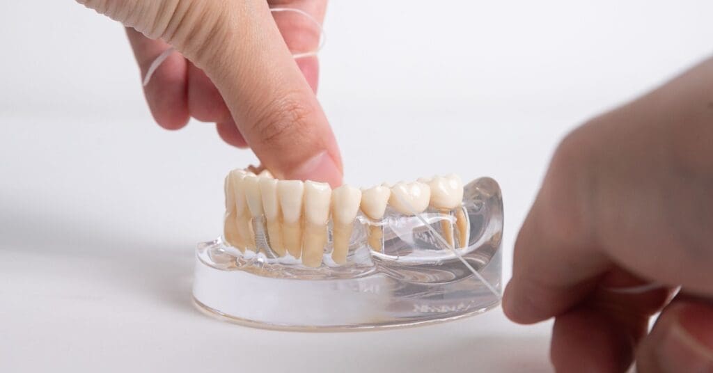 dental bridge