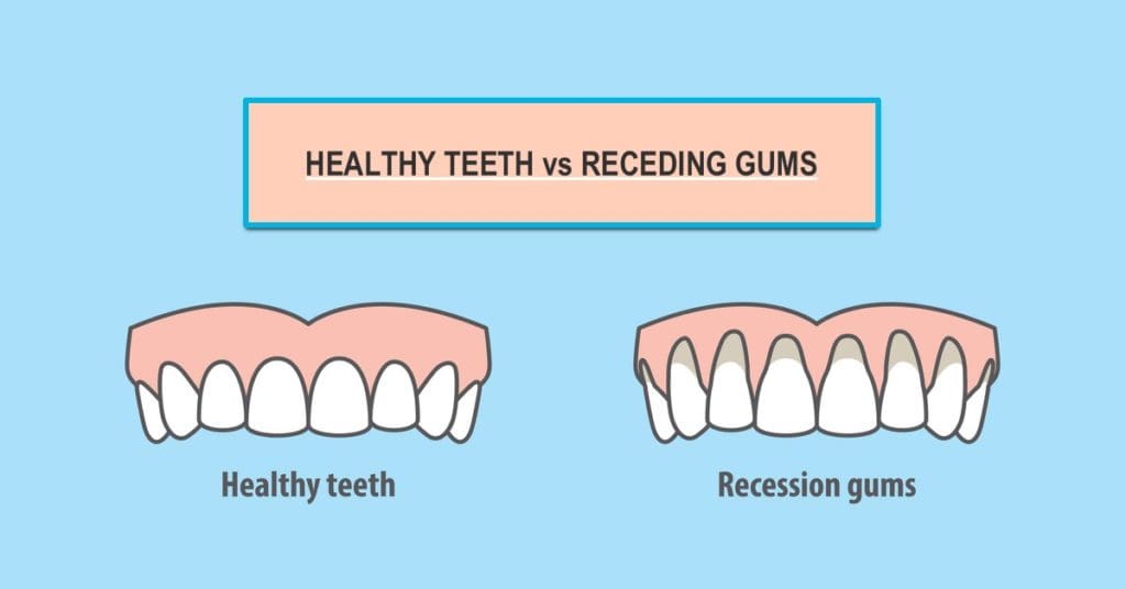 5 Main Causes of Receding Gums