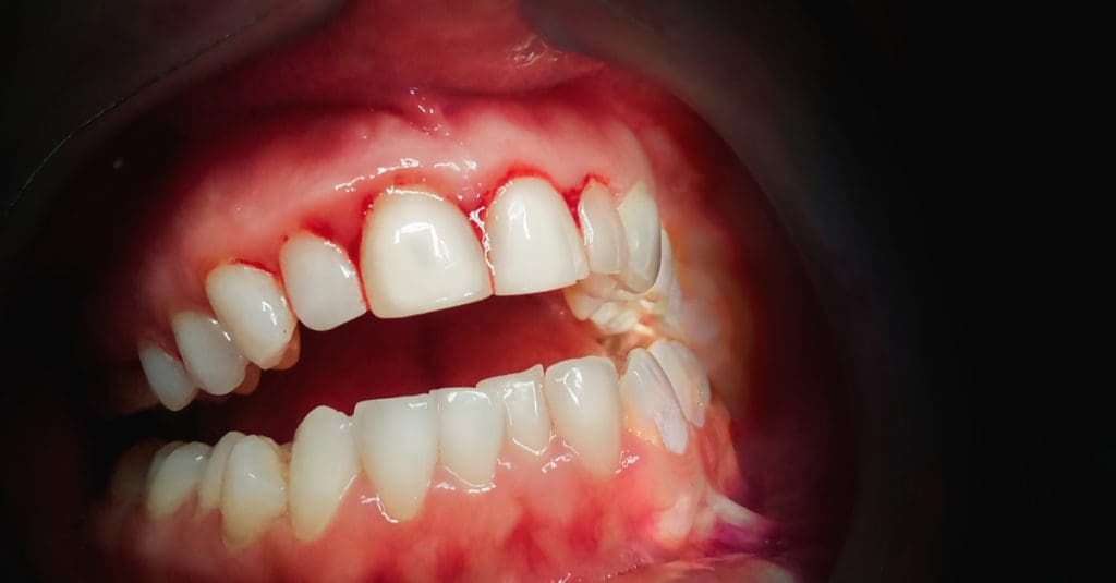 Periodontitis, Periodontal Disease Stages