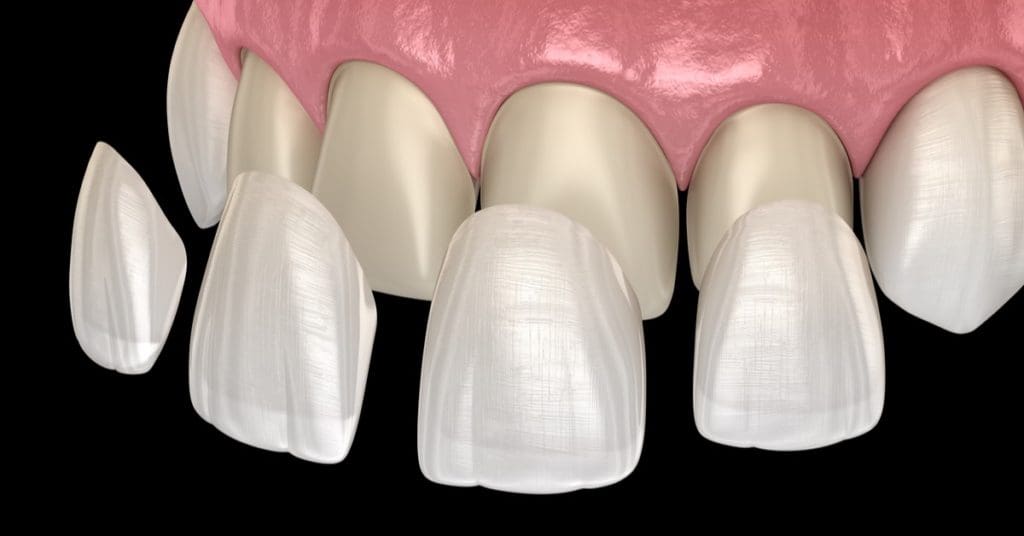Difference Between Dental Crowns & Veneers, Pros, Cons