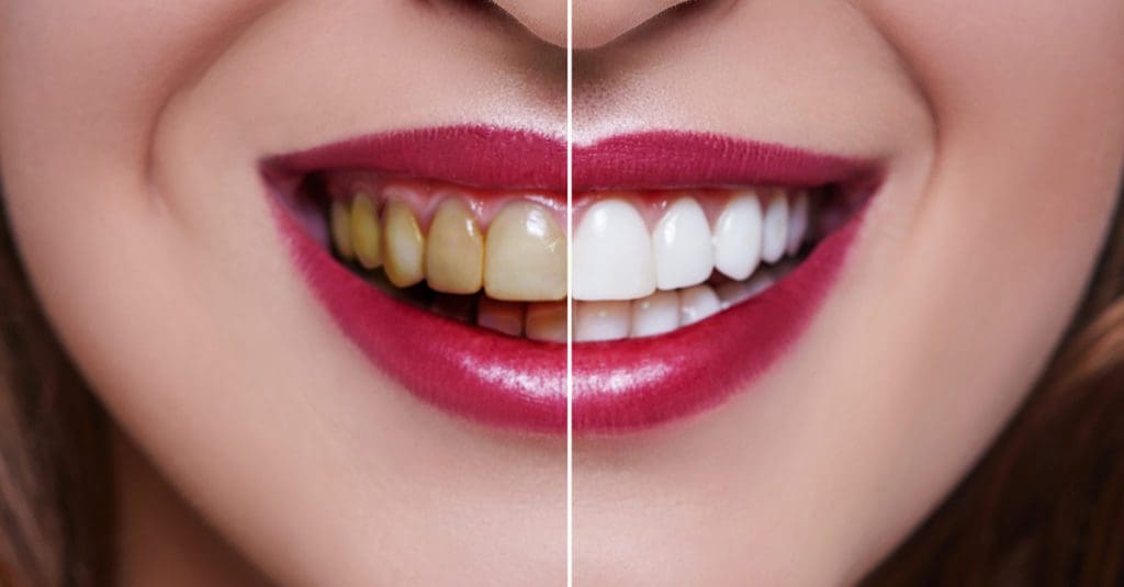 Cosmetic Dentistry, Veneers and the Process showing before and after
