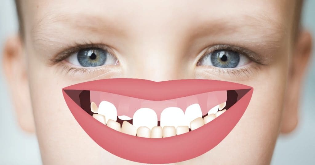 Underbite Correction: Causes, Treatment