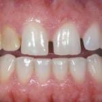 dental veneers before