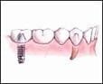 dental implant for missing tooth