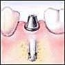 dental implant step 3