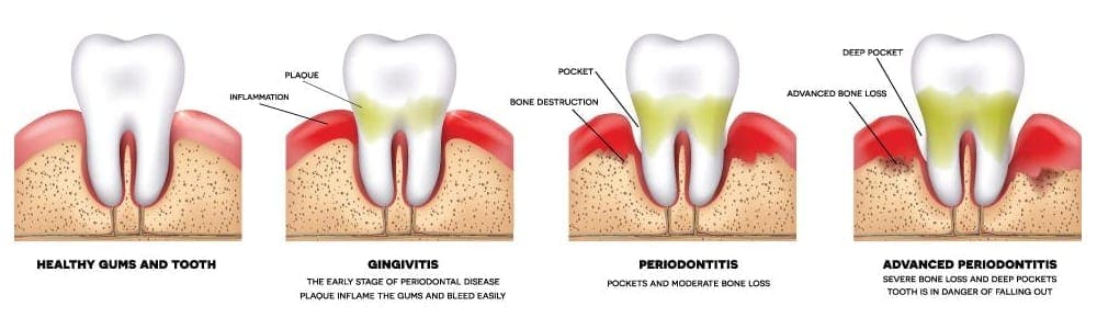 periodontitis inflammation of gums