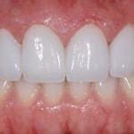 dental veneers after