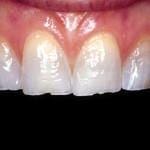 dental veneers before