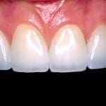 dental veneers after