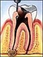 Root canal step 1