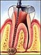 root canal therapy step 2