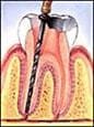 Root canal step 3