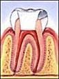 Root canal step 4
