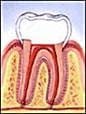 Root canal step 5