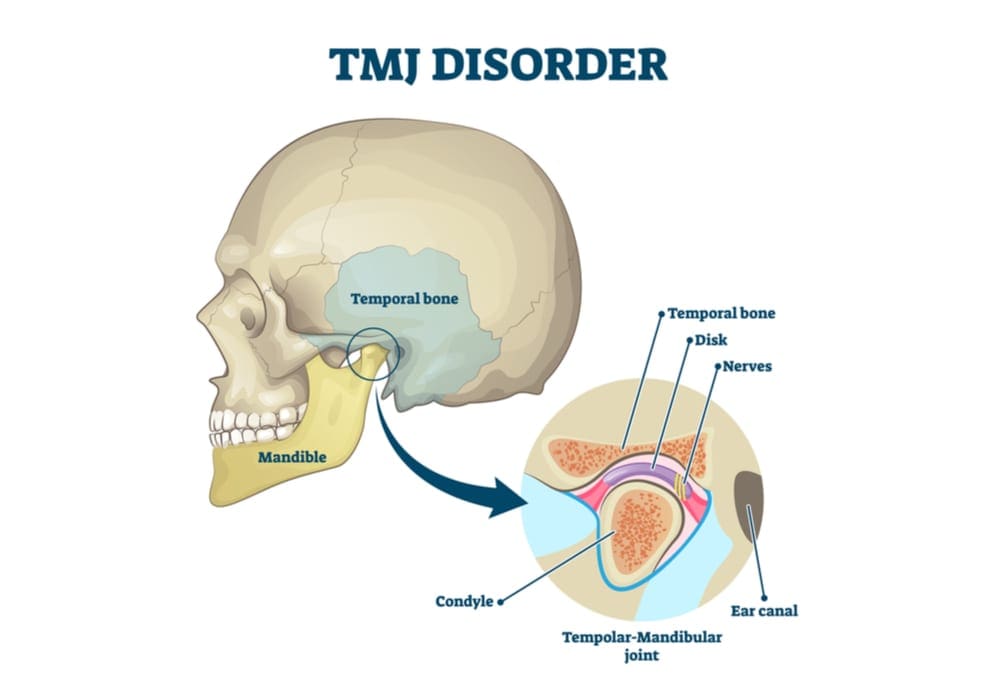 TMJ Therapy