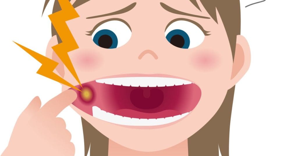 Mouth Ulcers: Causes, Treatment, Prevention