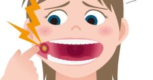 Mouth Ulcers: Causes, Treatment, Prevention