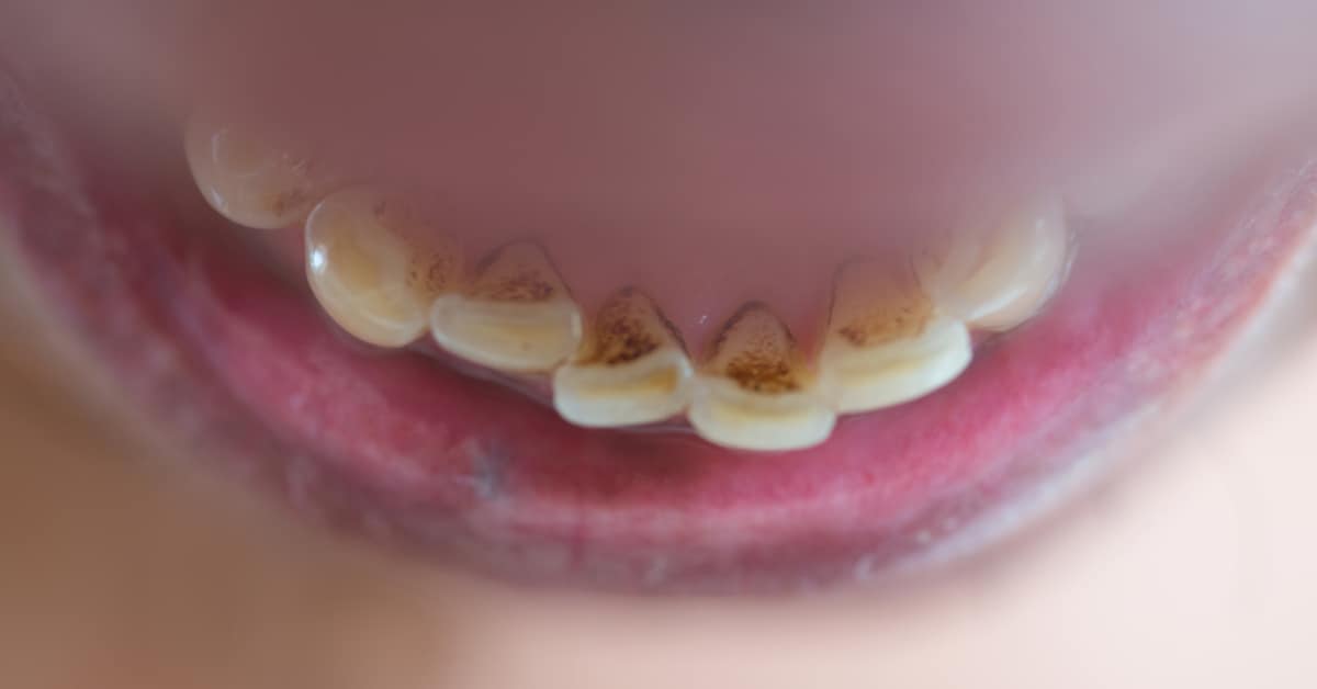 eroding teeth in a mouth